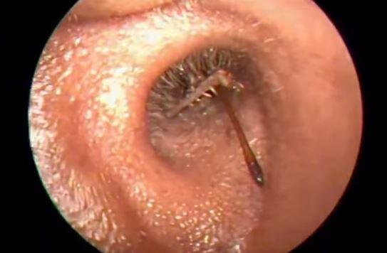 7 Living Things Found Inside The Ear Canal That Will Make ...