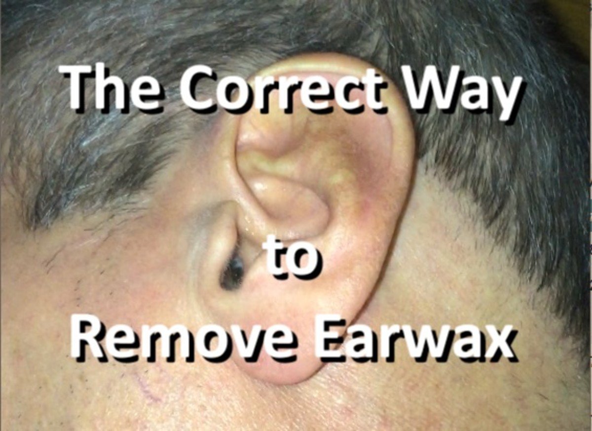 A Correct Way to Remove Impacted Earwax That Worked for Me ...