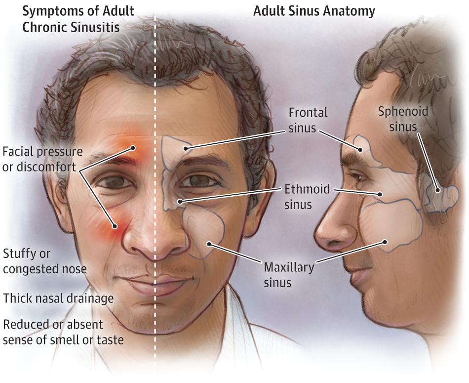 Adult Chronic Sinusitis.