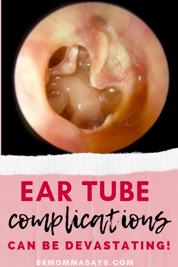Avoid 7 Undesirable Ear Tube Complications with Routine ...