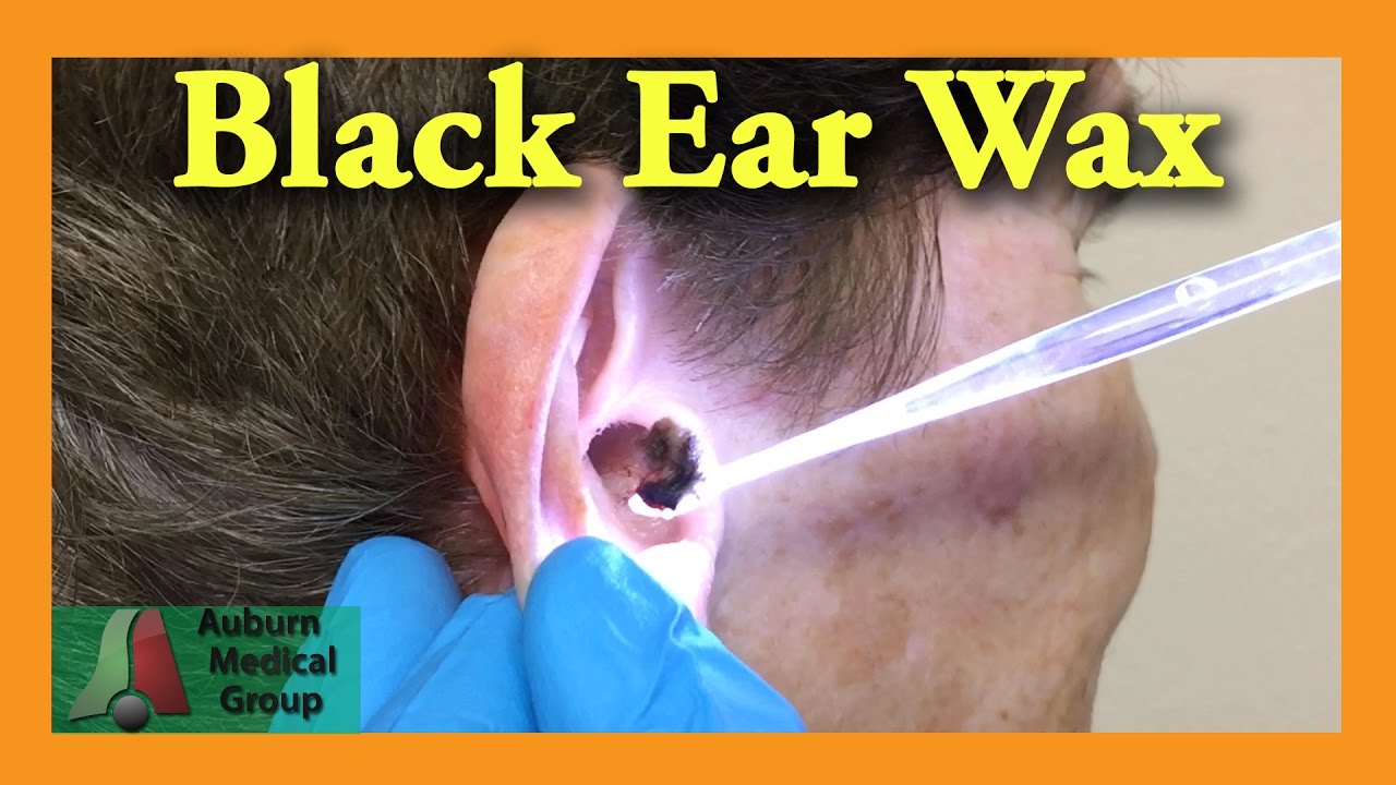 Black Ear Wax Removal
