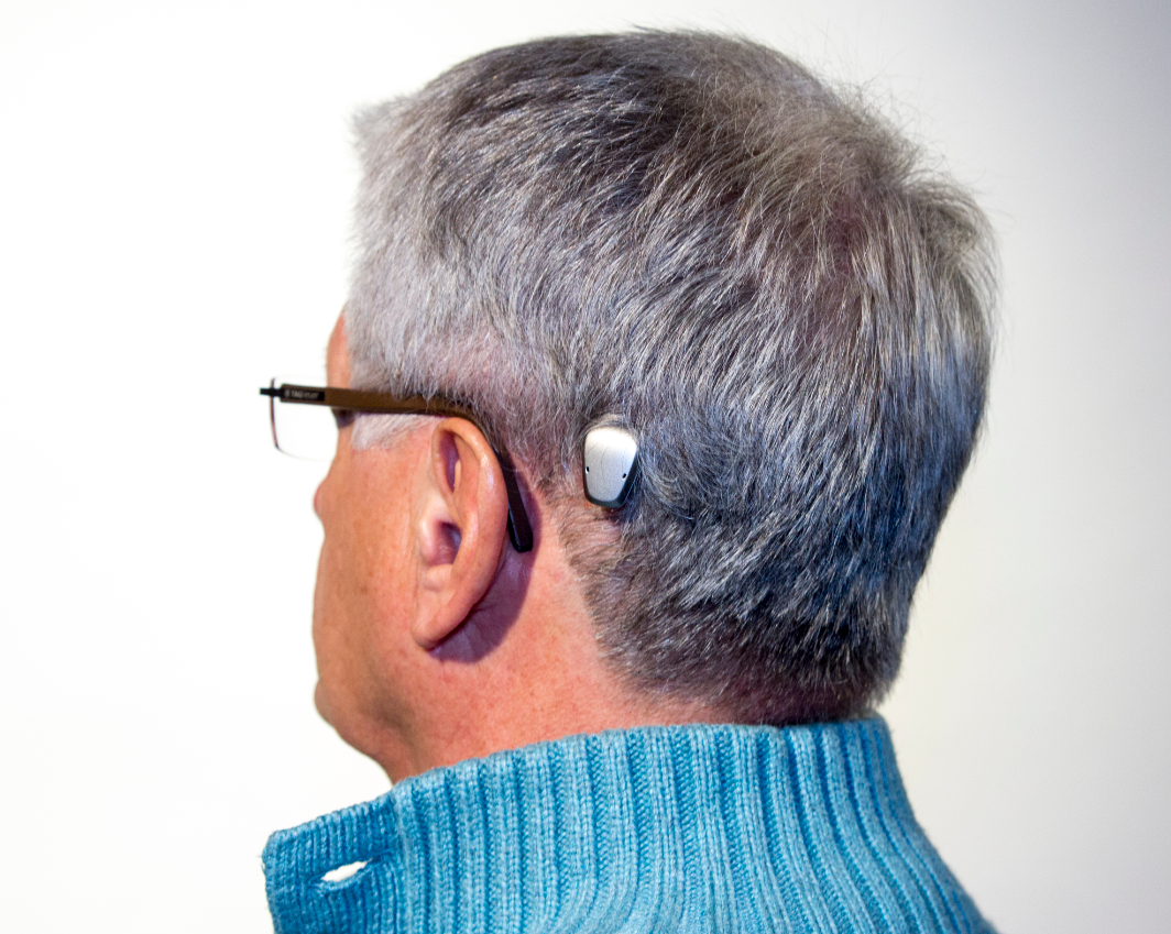Bone Anchored Hearing Devices