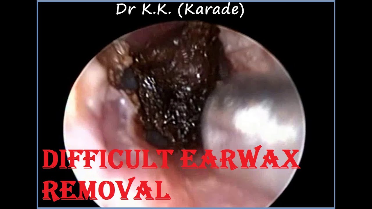 Both Ear Difficult Earwax Removal : Narrow Hairy Ear Canal ...