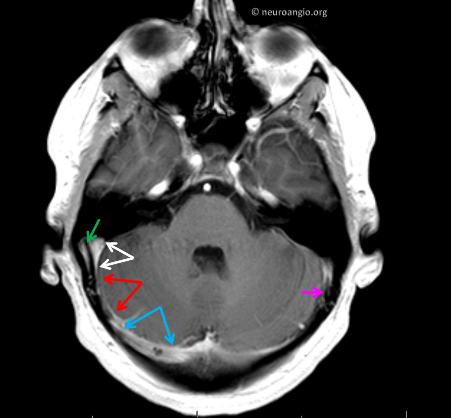 Brain Tumor Causing Tinnitus