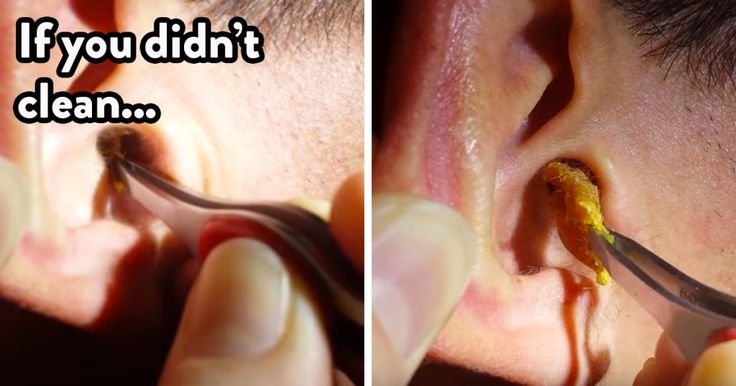 Causes and Brilliant Tips for Removing Earwax at Home ...