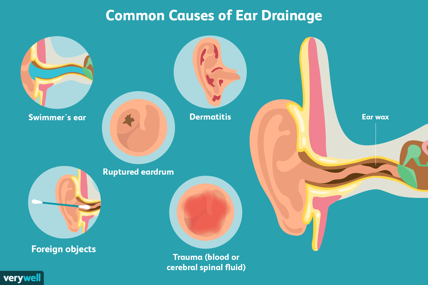 Causes and Treatment for Ear Drainage