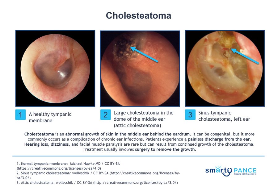Cholesteatoma