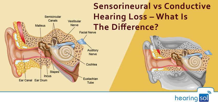 Conductive vs Sensorineural Hearing Loss