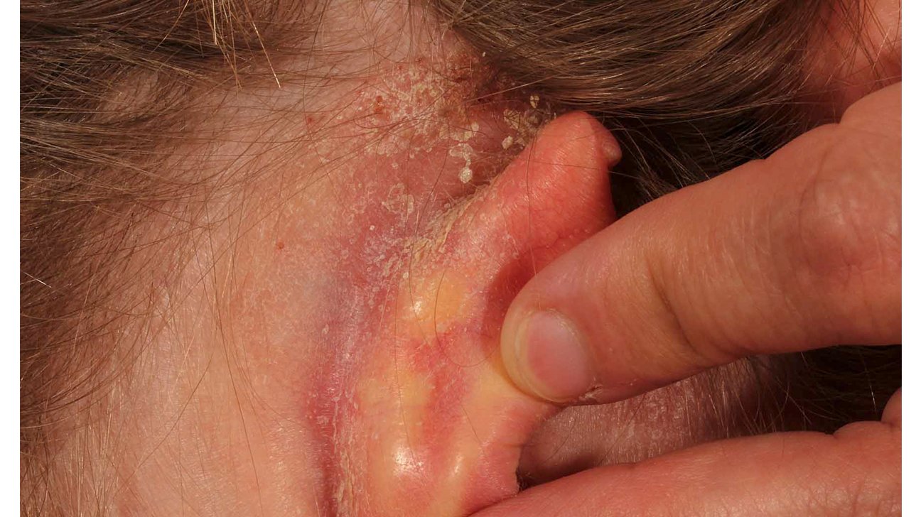 Crusty Skin Behind Ear