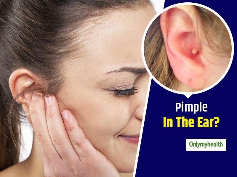 Dealing With A Pimple In Ear? Here Are Some Home Remedies With Monsoon ...