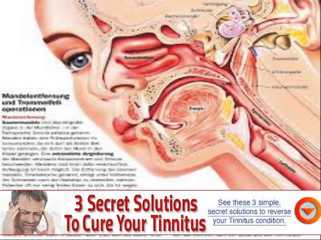 dealing with tinnitus acupuncture