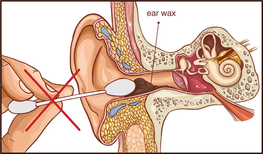 Does earwax microsuction hurt? All of your questions ...