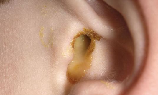 Ear Drainage, Smelly, Clear Discharge, Pus, Blood Draining ...