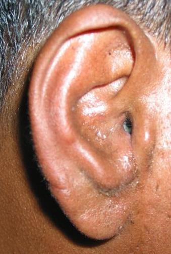 Ear Infection In Diabetics Can Be Deadly