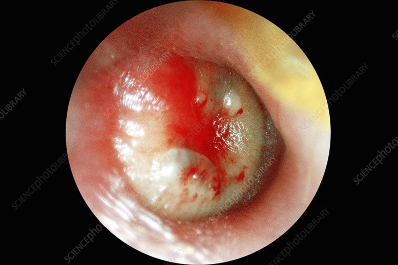Ear infection, otoscope view