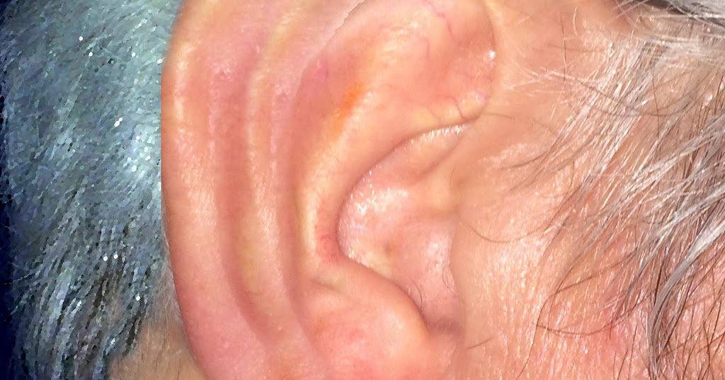 Ear infection,Earn pain,Causes and Treatment