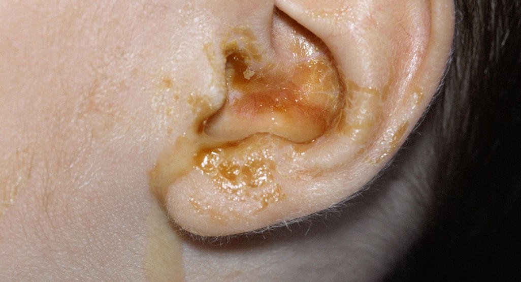 Ear infections in babies