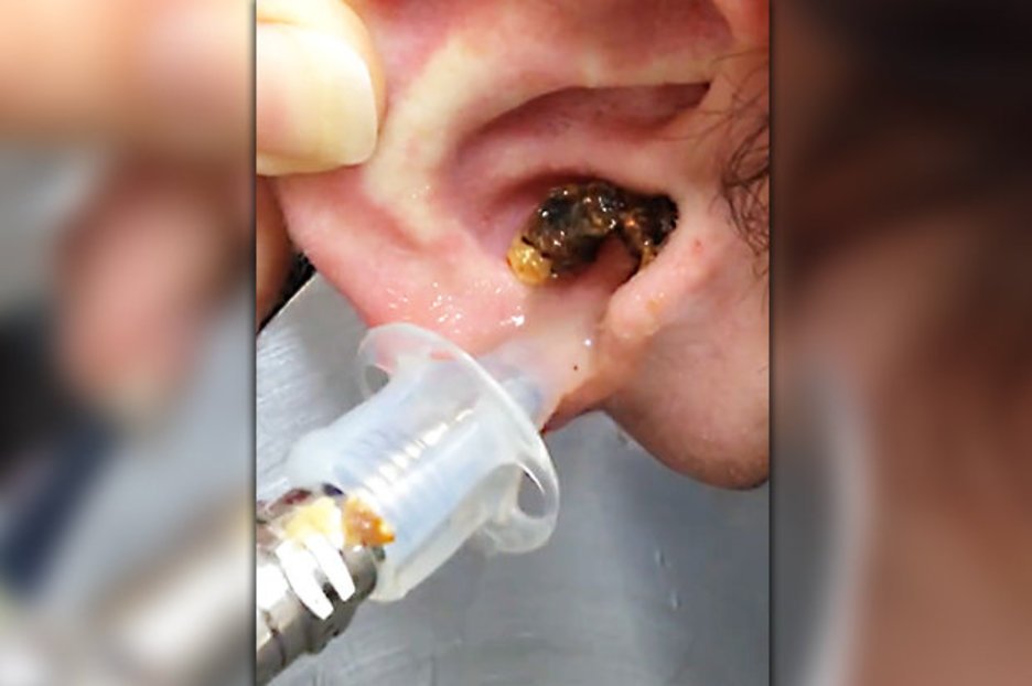 Ear wax pours from man