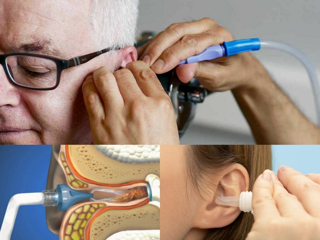 Ear Wax Removal for Tinnitus Treatment