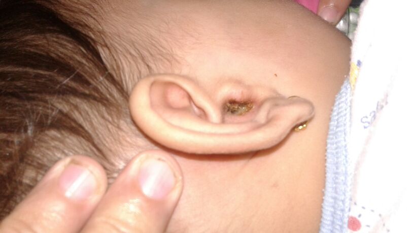 Fungus infection in my babies ear