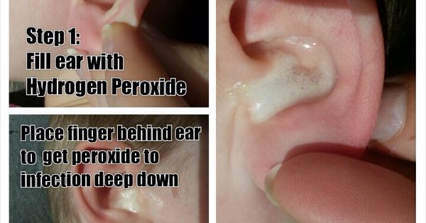 Good way to treat ear infections without antibiotics ...