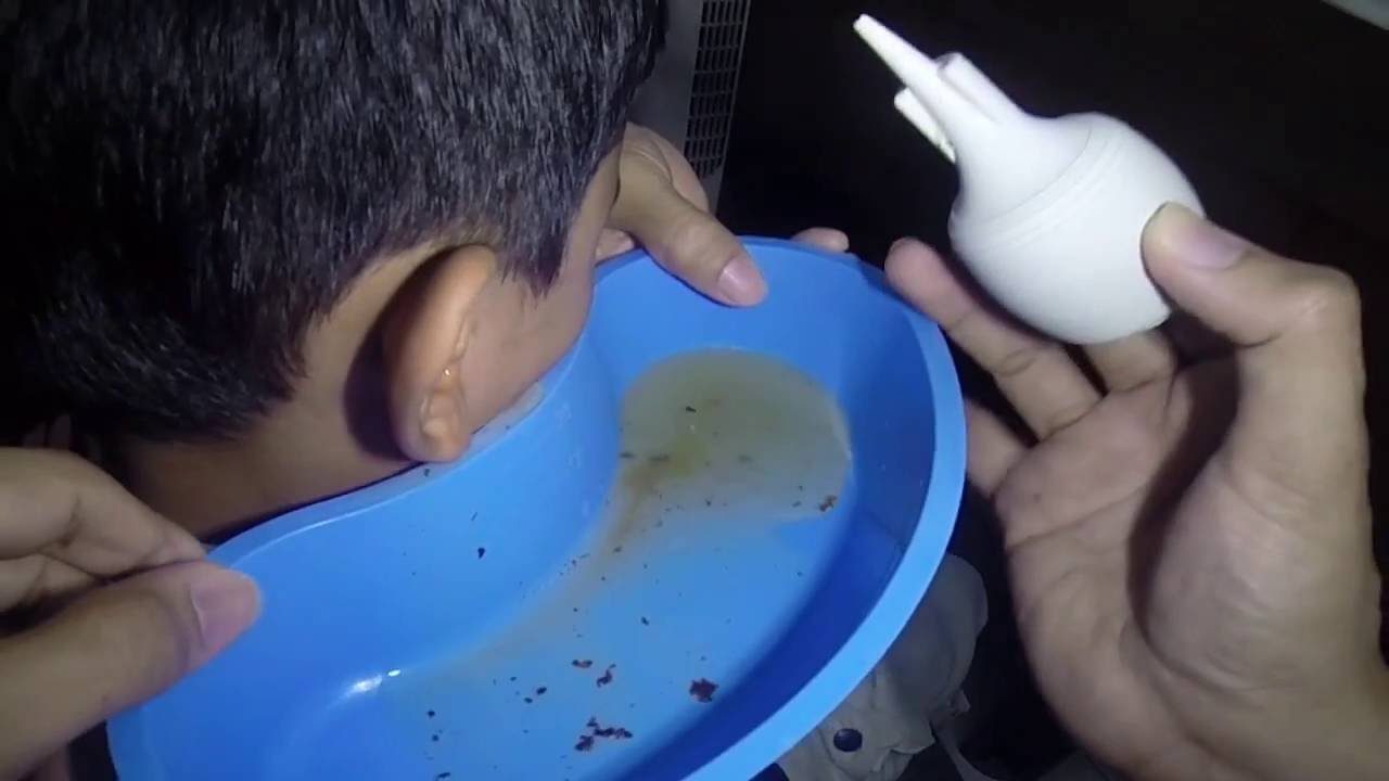 Hard &  Massive Earwax Removal by Ear Irrigation