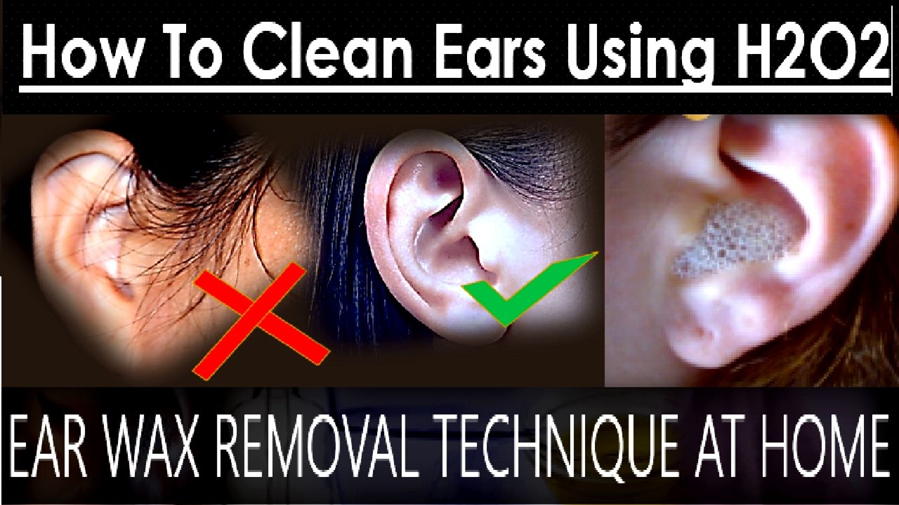 How to clean ears with hydrogen peroxide and water ...