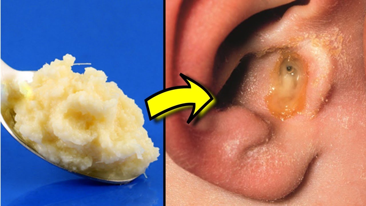 How to Cure Ear Infection Naturally at Home