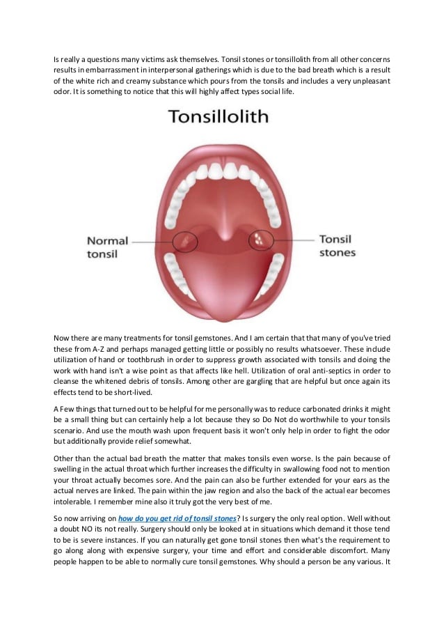 How to Get Rid of Tonsil Stones Forever