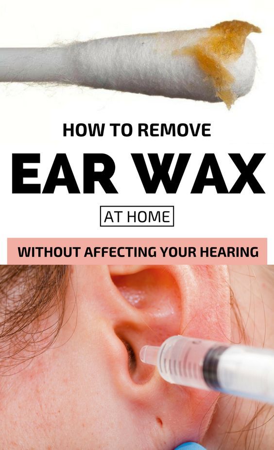 How To Remove Earwax Plug At Home