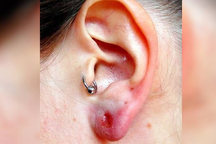 How to Treat an Infected Ear Piercing without it Closing