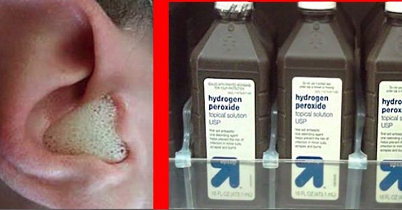 How To Use Hydrogen Peroxide For Ear Infections