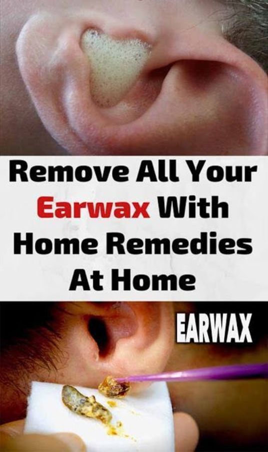 HOW TO USE HYDROGEN PEROXIDE TO REMOVE EAR WAX in 2020 ...
