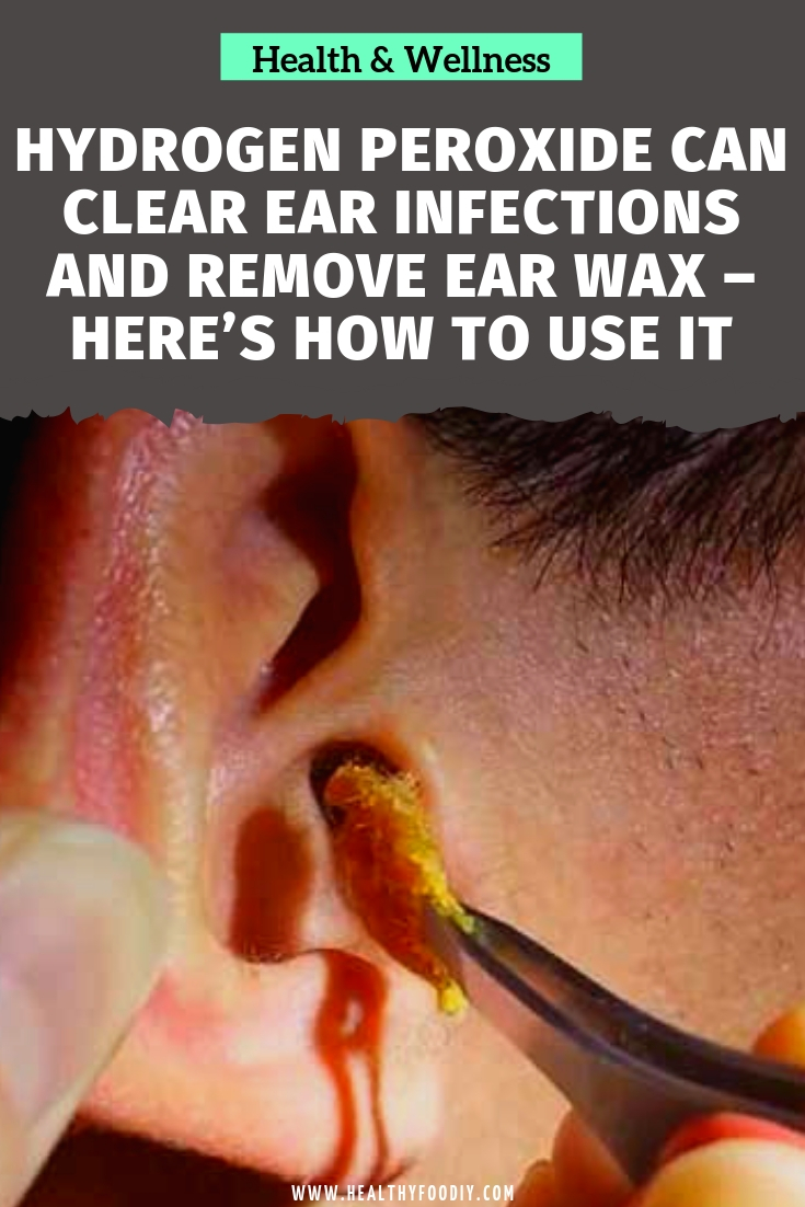 Hydrogen Peroxide Can Clear Ear Infections and Remove Ear ...