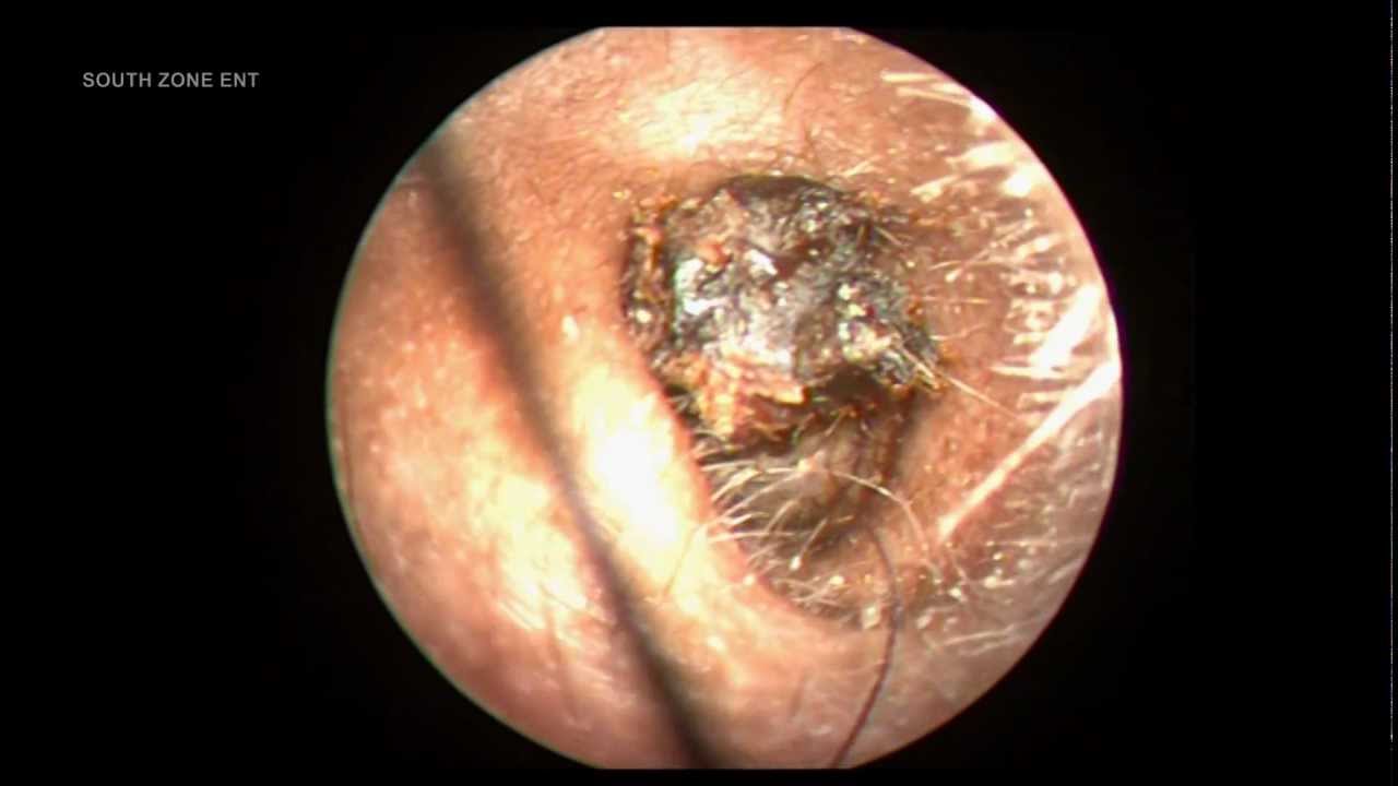 IMPACTED EAR WAX DIFFICULT TO REMOVE.