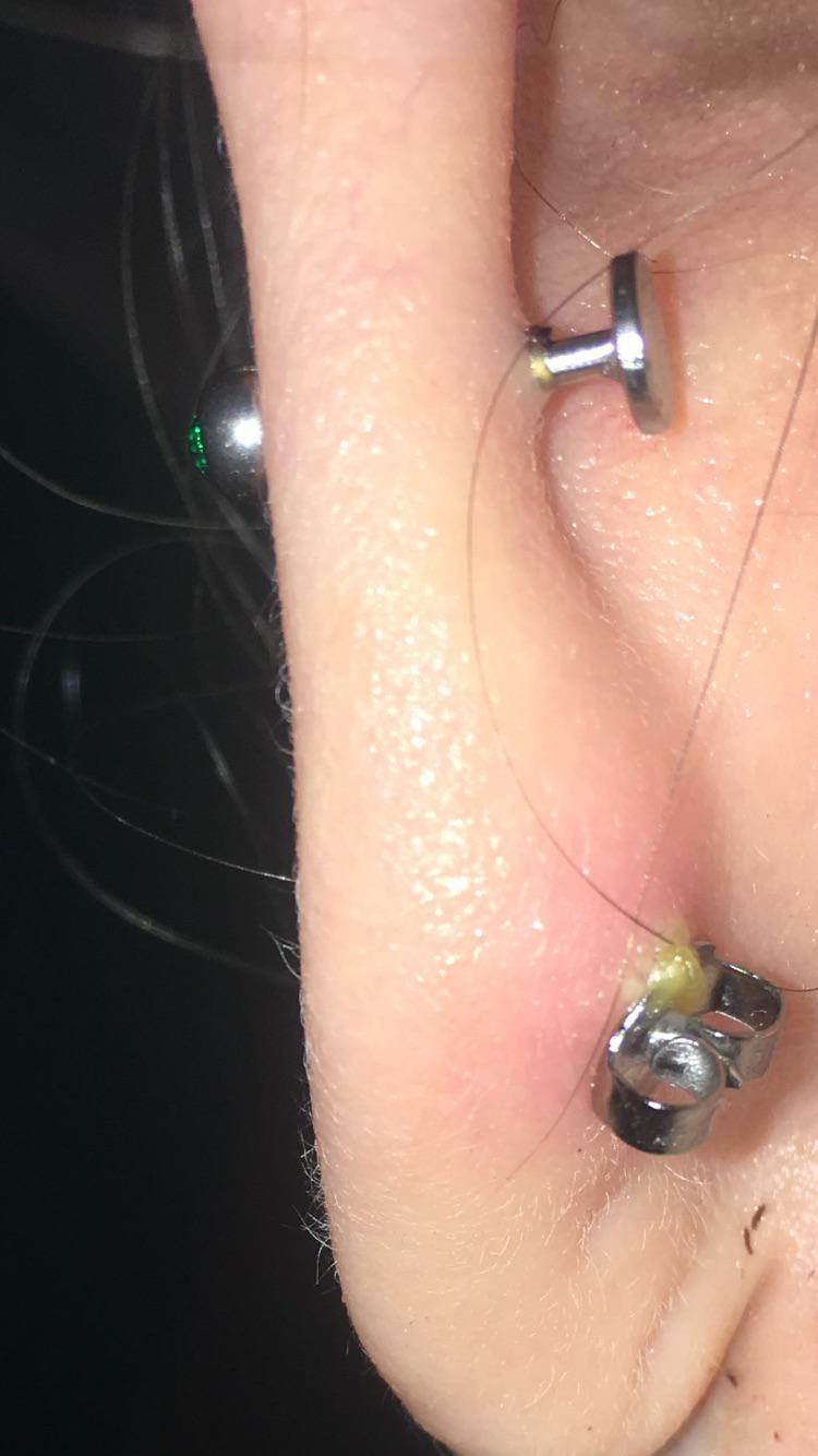 Infected ear lobe with fresh piercings on the same ear ...