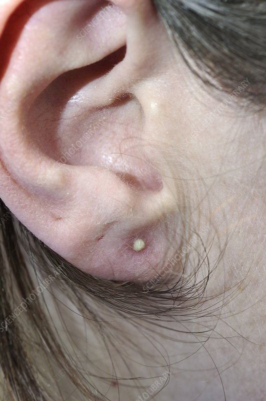 Infected earlobe from ear piercing