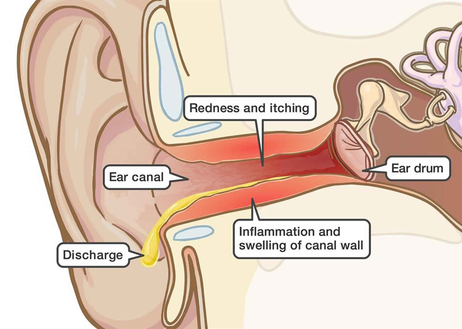Itchy inside ear, itchy painful ear causes &  treatment