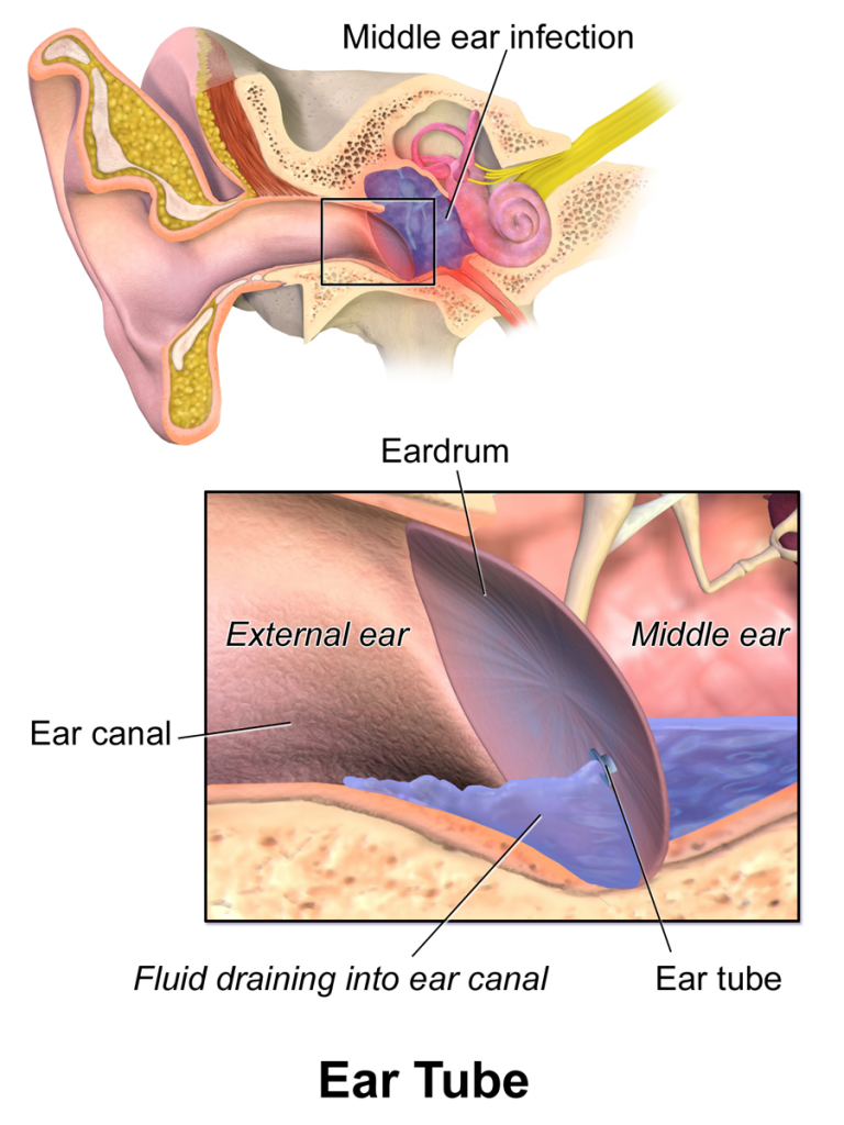 Managing Middle Ear Fluid in Adults