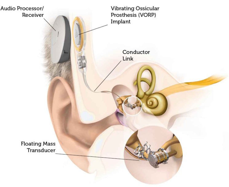 Middle ear implants