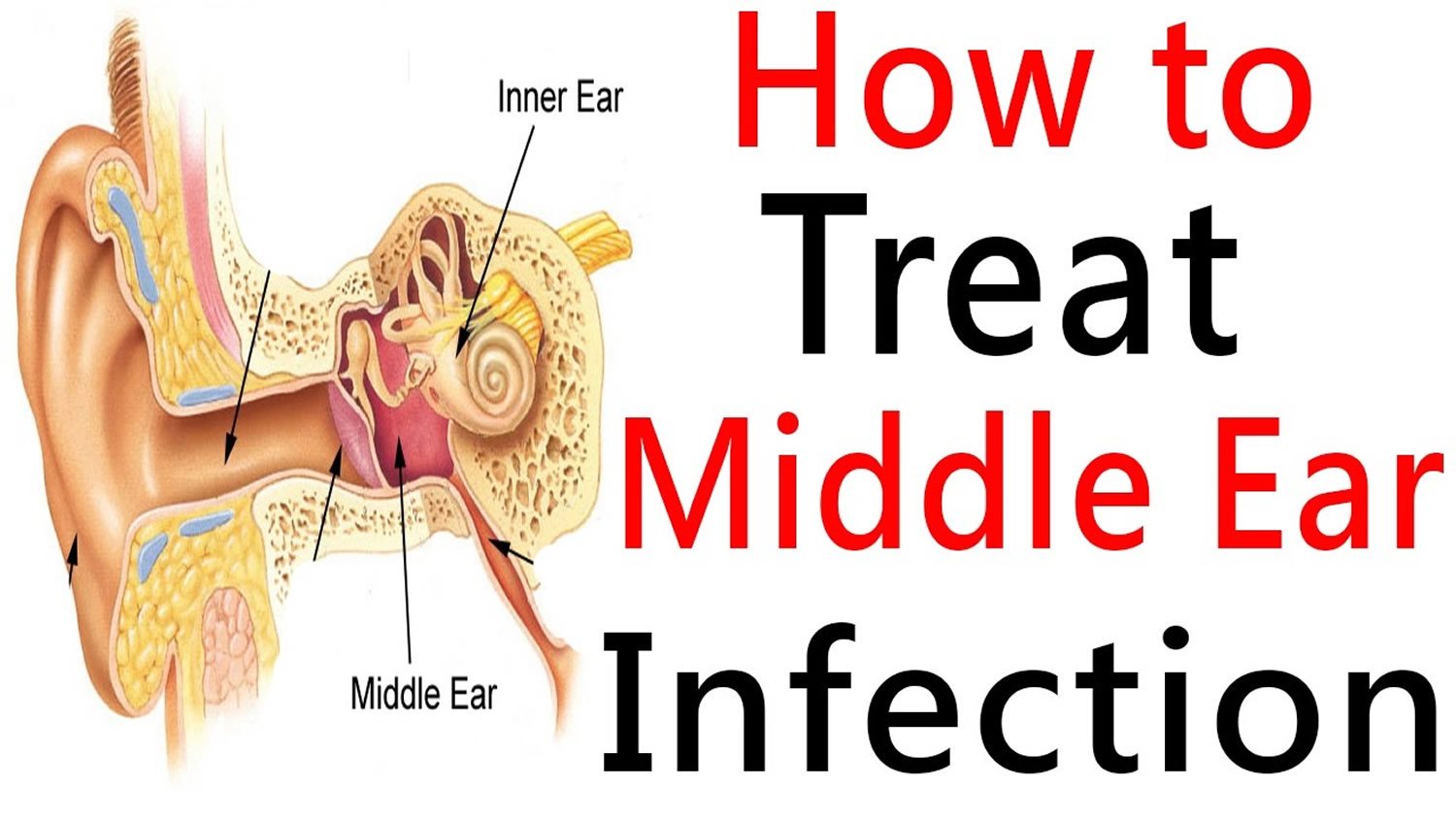 Middle Ear Infection &  Middle Ear Effusion