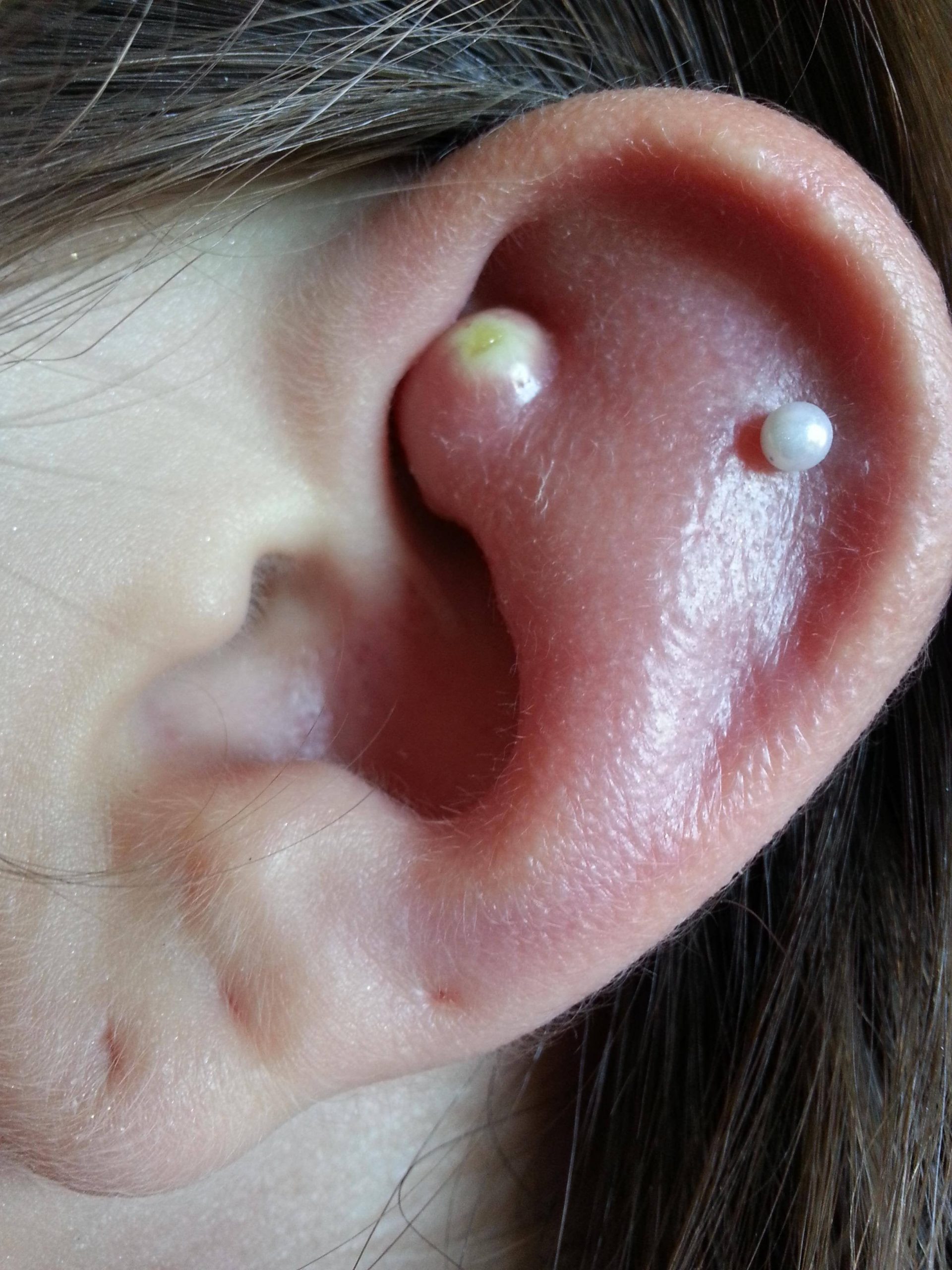 My sisters ear after taking an infected rook piercing out. : WTF