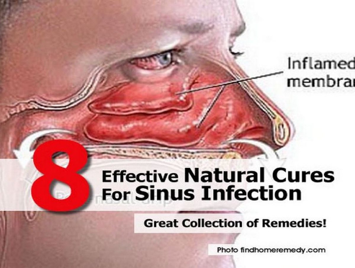 Natural cures for sinus infection, noise induced tinnitus ...