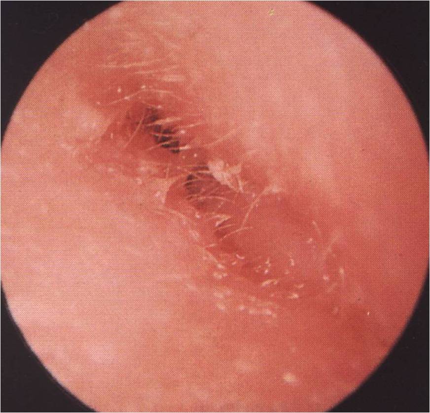 Otitis Externa (outer ear infection) or swimmers ear