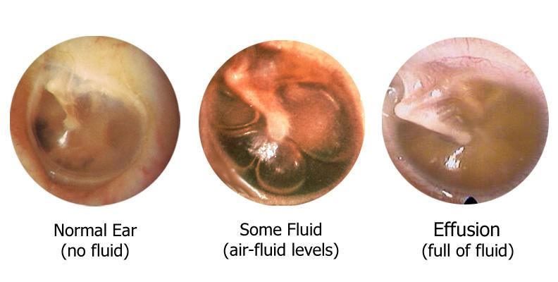 How To Clear Fluid From Middle Ear (4)
