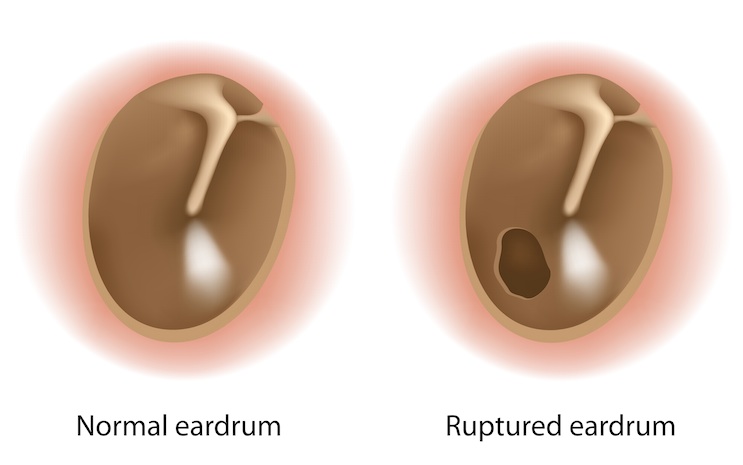 Perforated Eardrum Symptoms, Causes and Treatments