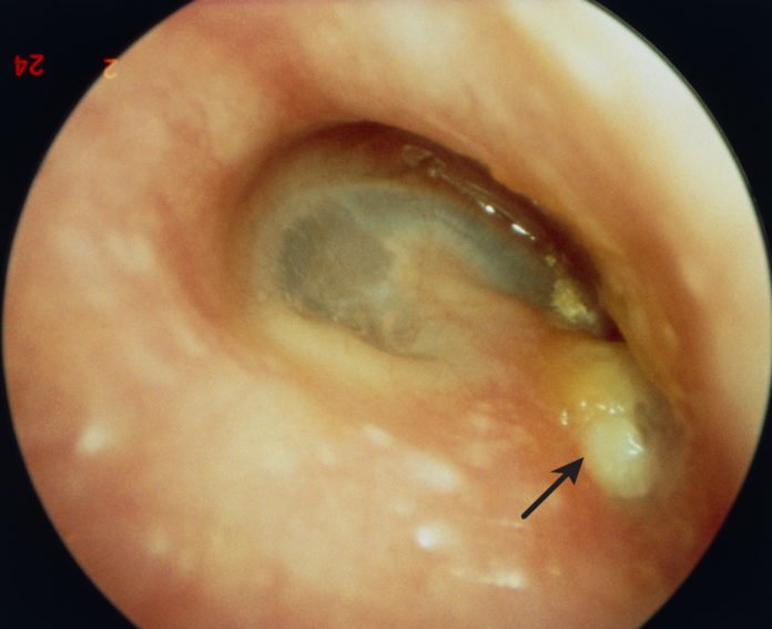 Pus in Ear: Condition, Signs, Treatment, and More