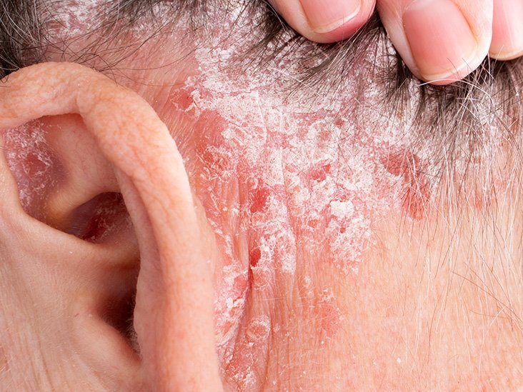 Rash behind ear: Causes, other symptoms, and treatment