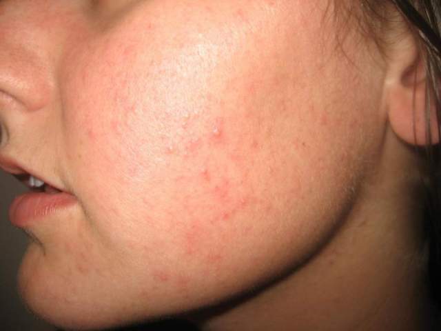 Red Bumps on My Face