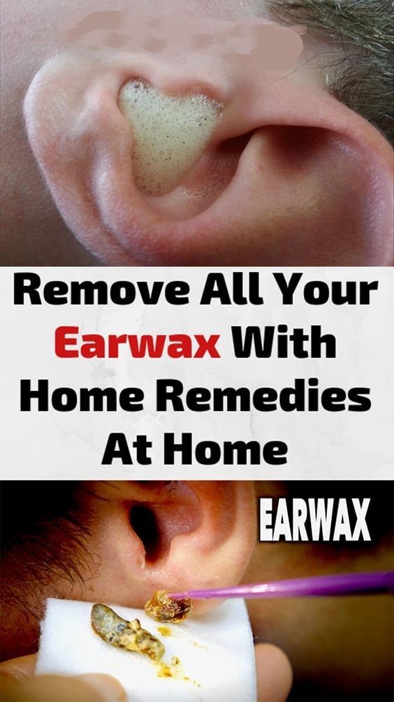 Remove All Your Earwax With Home Remedies At Home in 2020